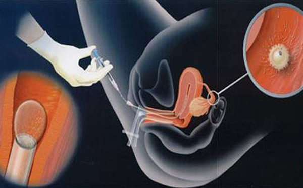 人文科技：人工受孕